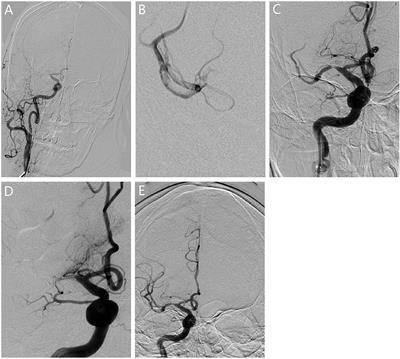 Association Between Occlusion Type and Etiology of Acute Intracranial Large Artery Occlusion